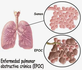 enfermedad-pulmonar-obstructiva-cronica